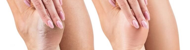 Ayush for cracked heels