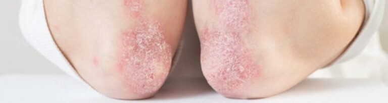 Ayush Ayurveda psoriasis management